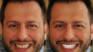 Despite Being Uncircumcised, Sal Governale Realized the Incredible Teeth-Whitening Power of the Yo App