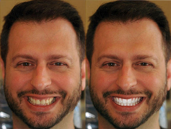 Despite Being Uncircumcised, Sal Governale Realized the Incredible Teeth-Whitening Power of the Yo App