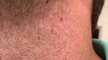 When Your Beard Hair is More Like a Vortex