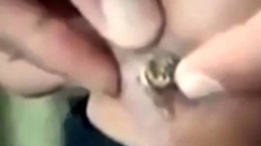 Guy Squeezes a Bullet Right Out of His Leg