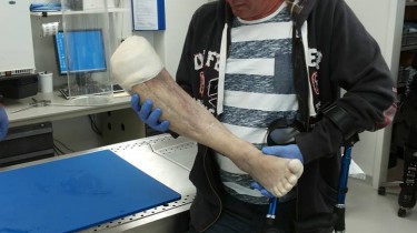 Not Everyone Can Say They Got to Hold Their Own Amputated Leg Like Leo Bonten Can